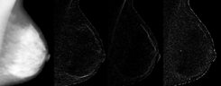 Wavelet decomposition of a mammogram